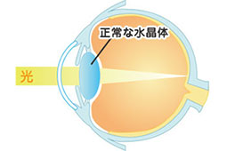 白内障 図解 正常な水晶体