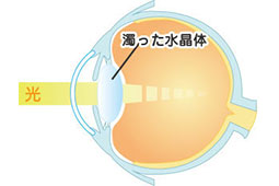 白内障 図解 濁った水晶体