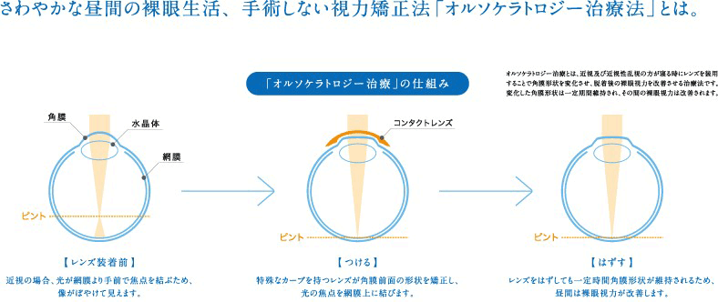 さわやかな昼間の裸眼生活、手術しない視力矯正法「オルケソラトロジー治療法」とは